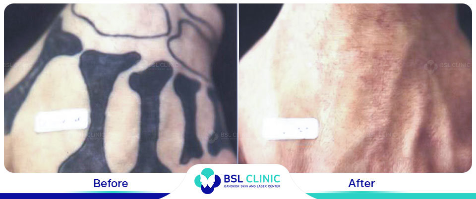 The results tattoo removal Asclepion Q Switched Ruby Laser