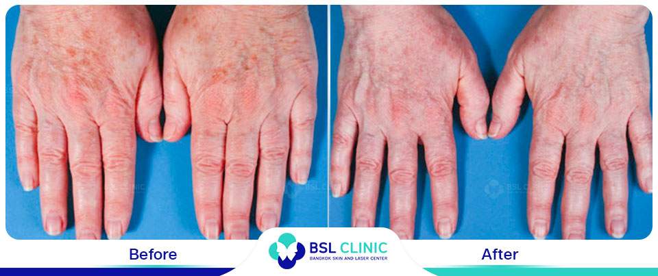 The results tattoo removal Asclepion Q Switched Ruby Laser