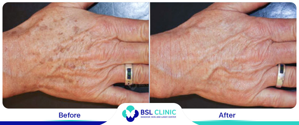 The results tattoo removal Asclepion Q Switched Ruby Laser