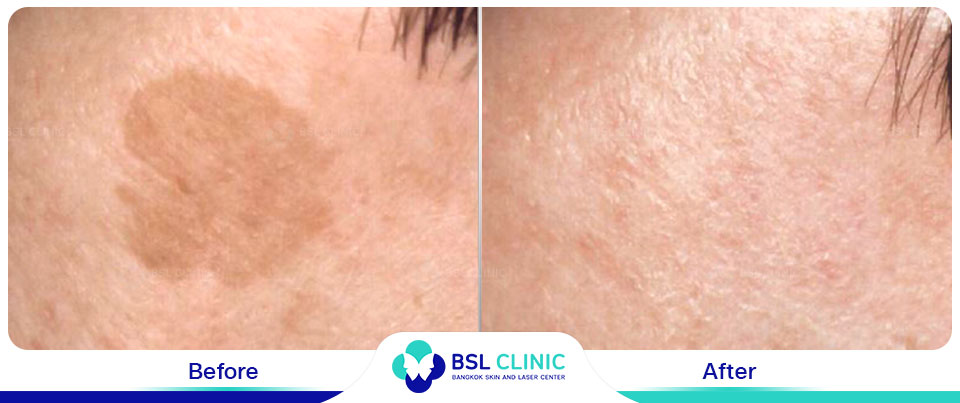 The results tattoo removal Asclepion Q Switched Ruby Laser