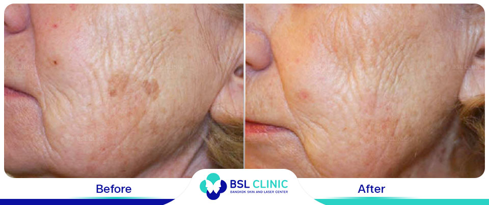 The results tattoo removal Asclepion Q Switched Ruby Laser