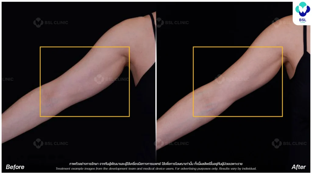 ultherapy prime ultherapy before and after arm 3 months ultherapy body treatment ultherapy in bangkok ultherapy bangkok price ulthera bangkok ultherapy thailand ultherapy upper arm skin tightening ultherapy thailand price ultherapy non invasive lift ultherapy before and after results bsl clinic