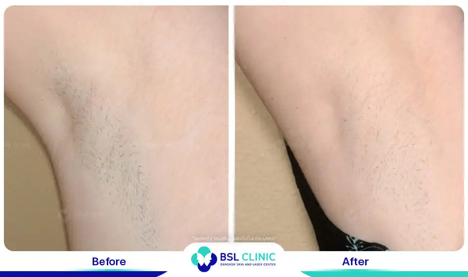 Underarm brightening and smoothening result