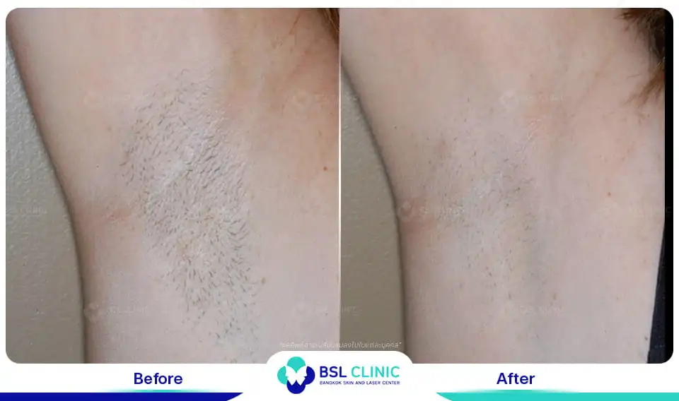 Underarm brightening and smoothening result