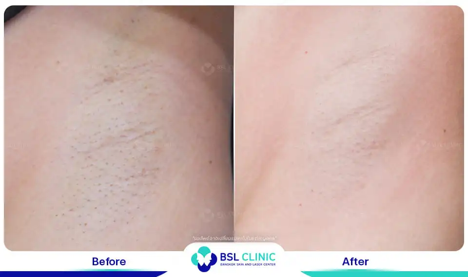 Underarm brightening and smoothening result
