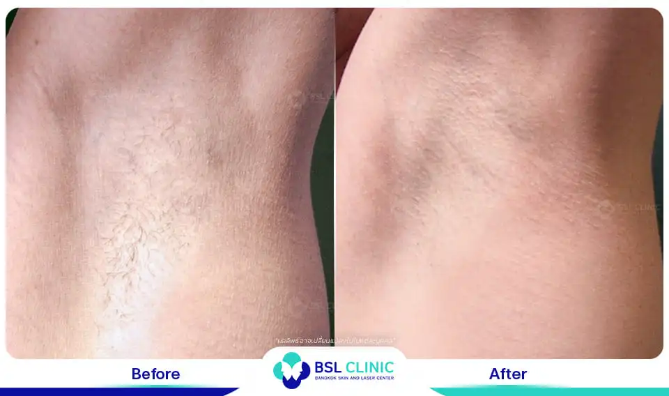 Underarm brightening and smoothening result