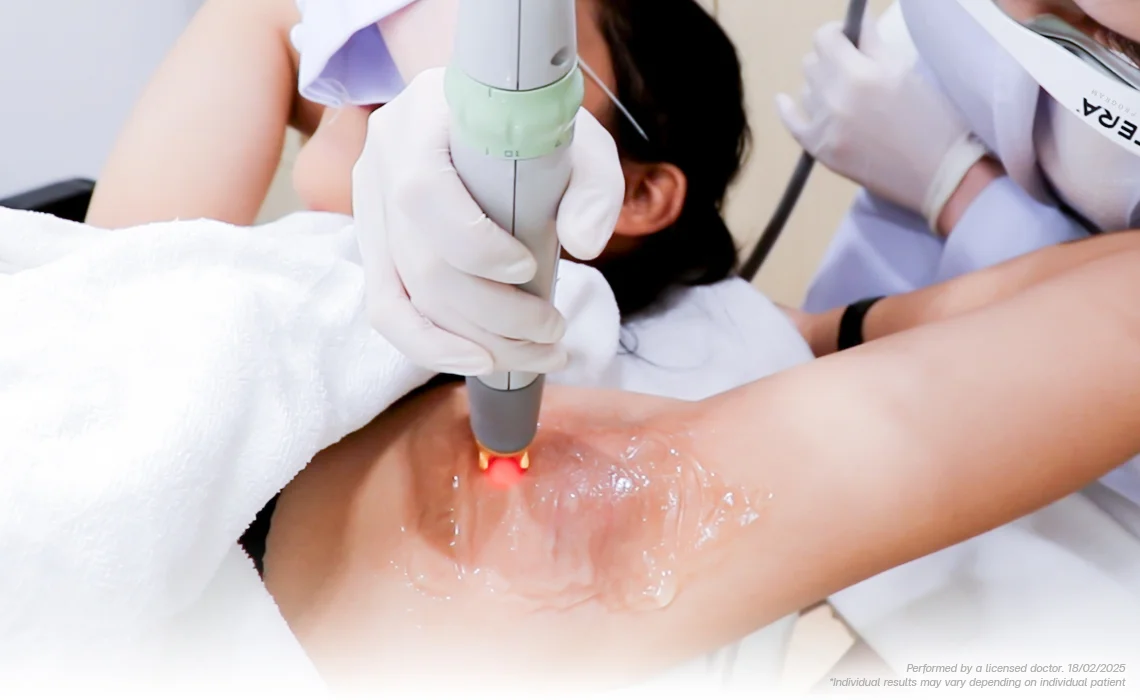 laser hair removal bangkok treatment session at bsl clinic using cutera coolglide and ipl hair removal programs