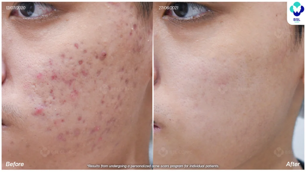 acne-scar-BA-630178-A-พงศภัค-ธุระกิจเสรี.webp