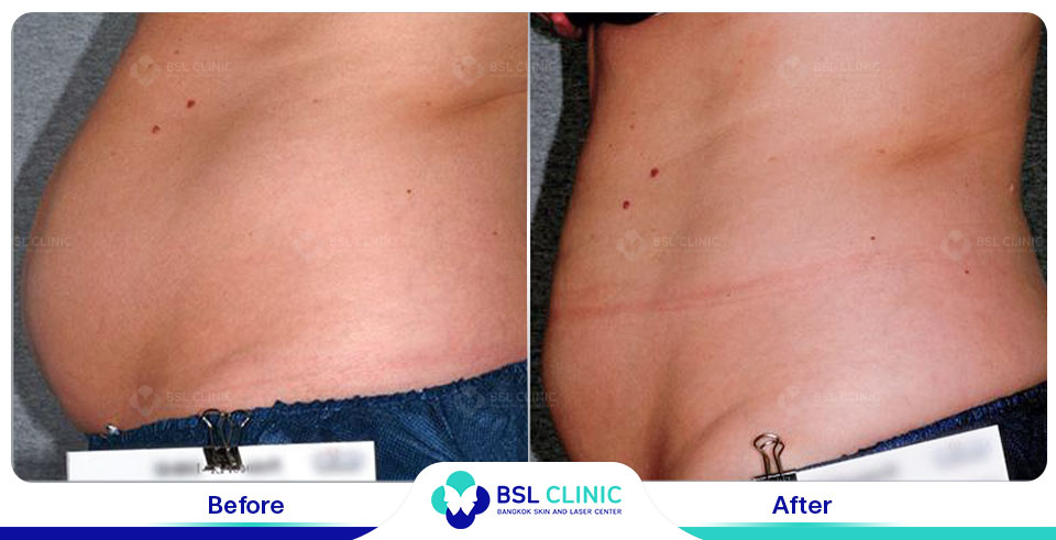 before after fat removal