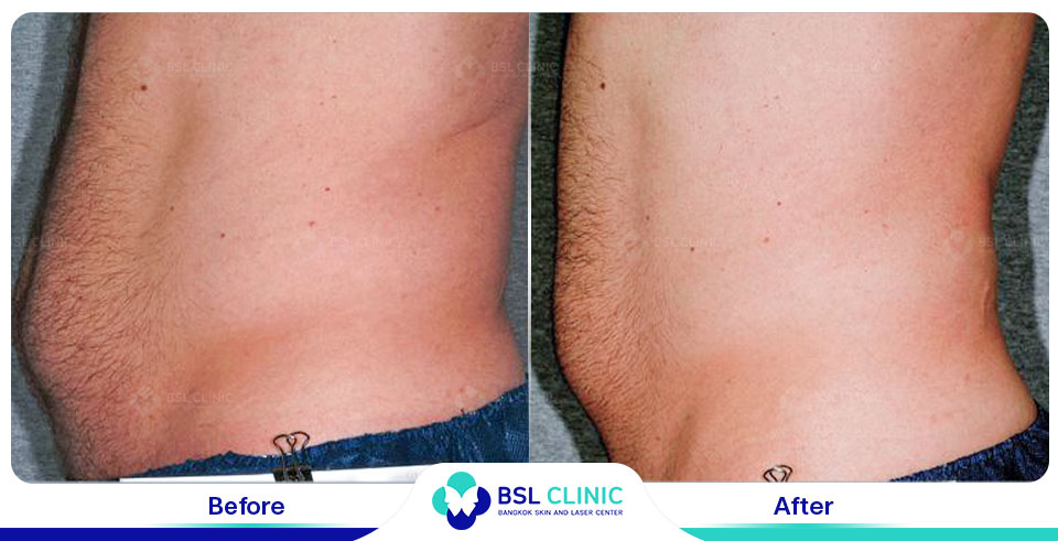 before after fat removal