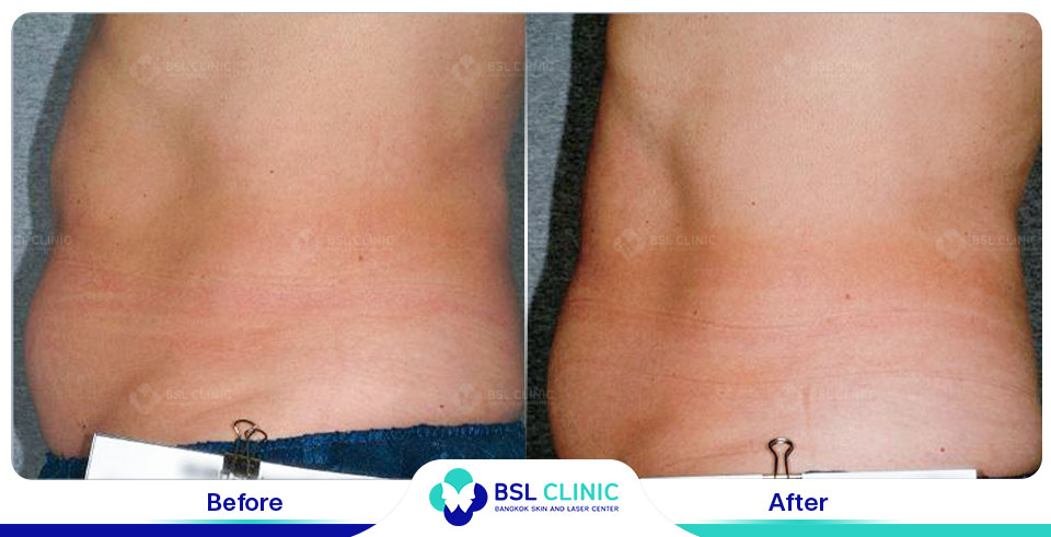 before after fat removal