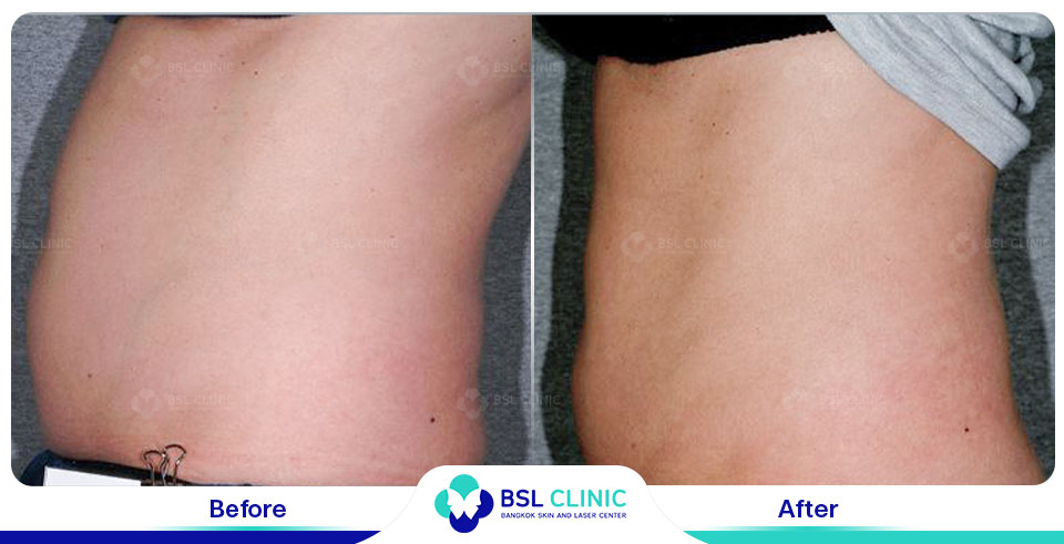 before after fat removal