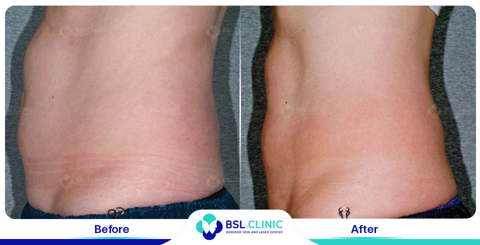 before after fat removal