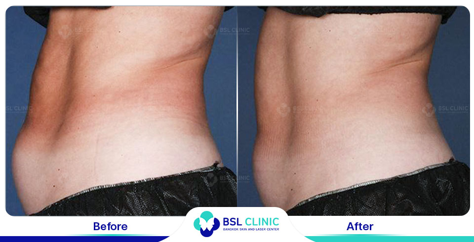 before after fat removal