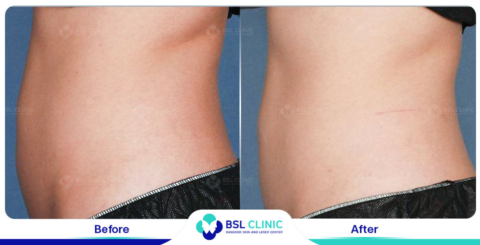 before after fat removal