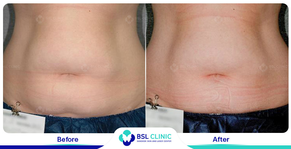 before after fat removal