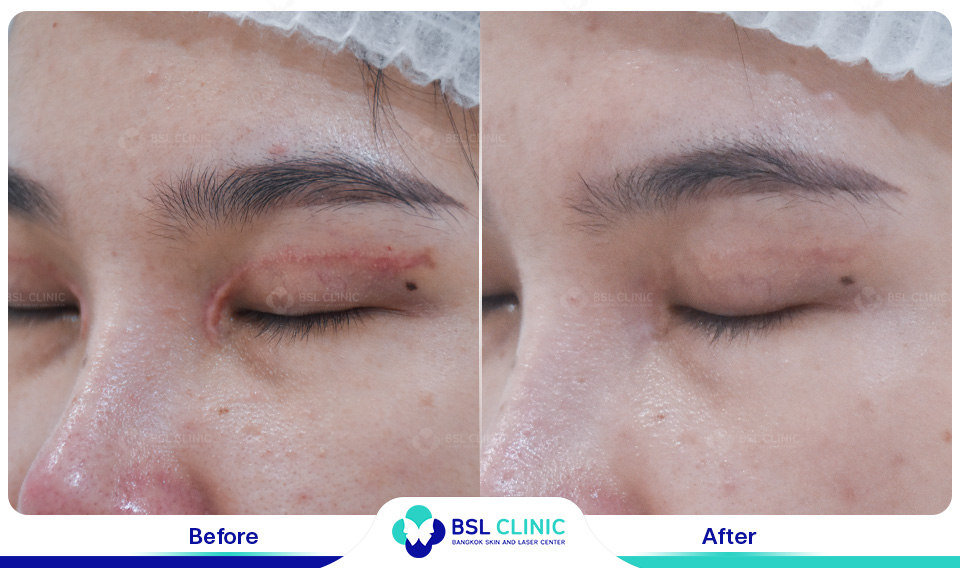 before after scars