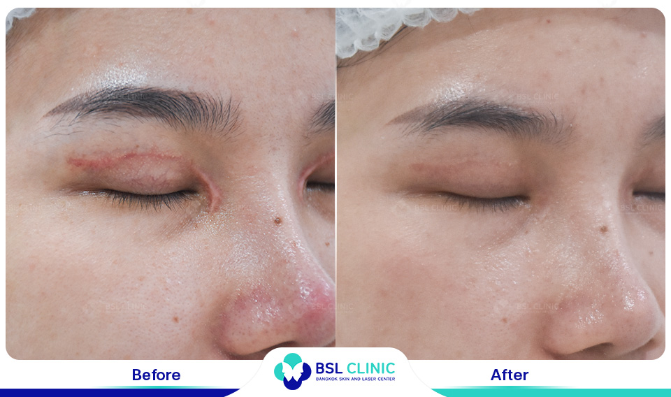 before after scars