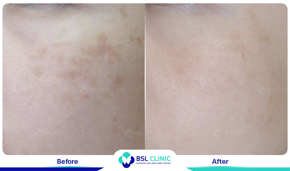 before-after-result