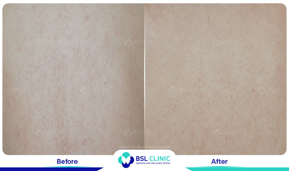 Keratosis Pilaris Treatments