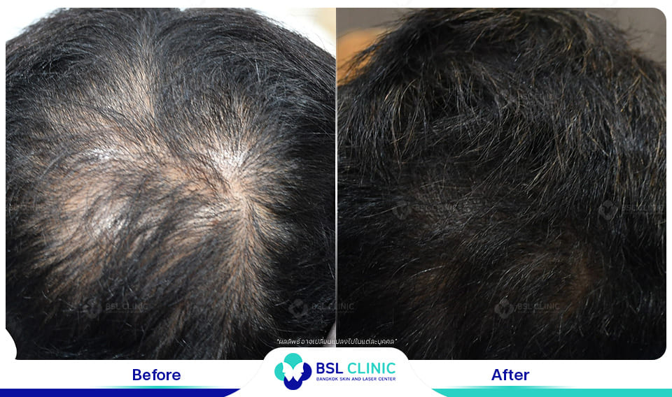 result hair regrowth