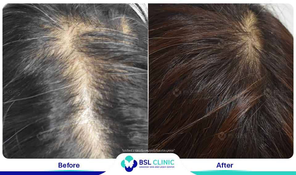 result hair regrowth