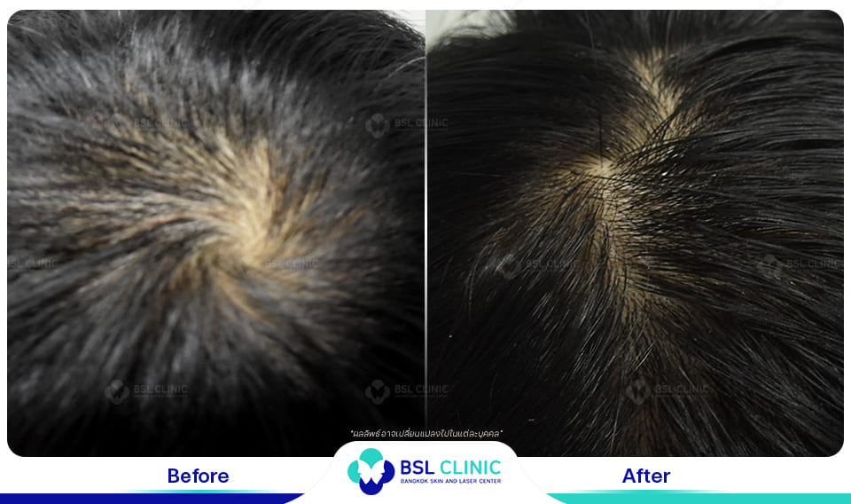 result hair regrowth