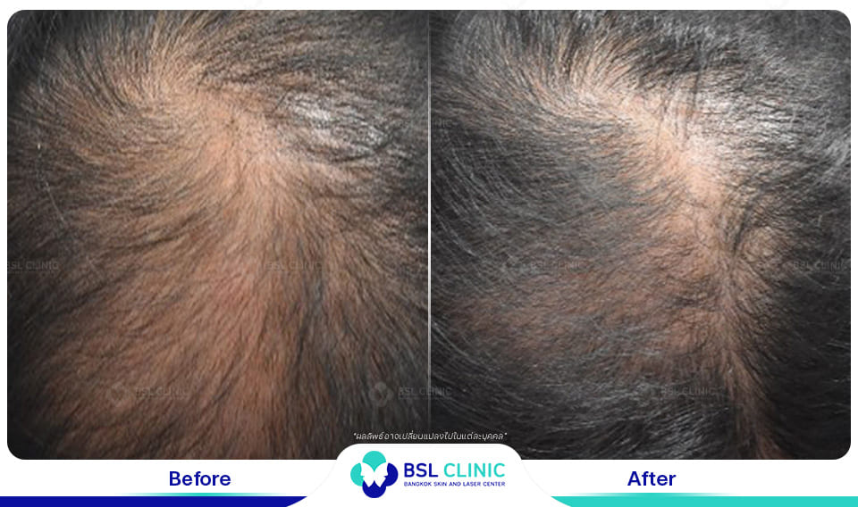 result hair regrowth