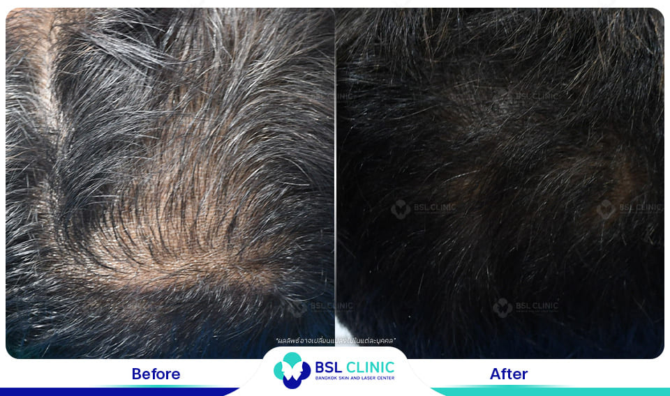 result hair regrowth