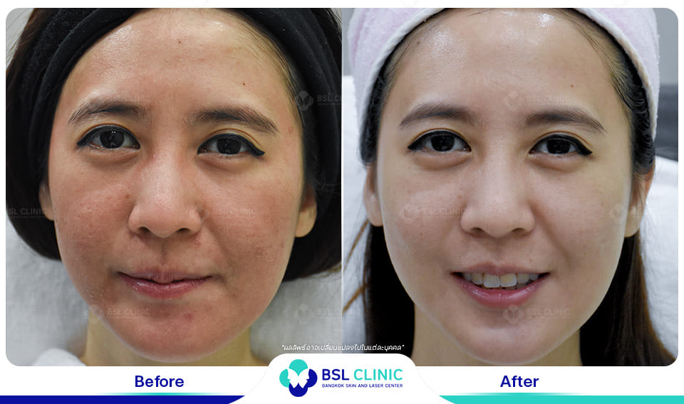 Before and After Treatments of Seborrheic Dermatitis