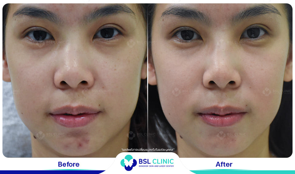 Before and After Treatments of Seborrheic Dermatitis