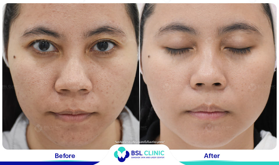 Before and After Treatments of Seborrheic Dermatitis