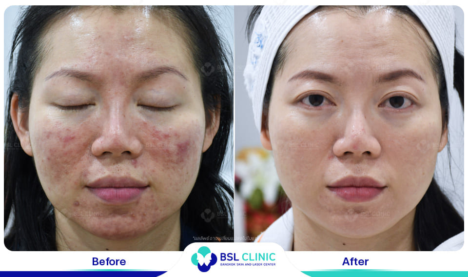 Before and After Treatments of Seborrheic Dermatitis