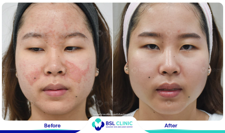Before and After Treatments of Seborrheic Dermatitis