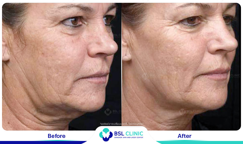before afte Face Lifting Treatments