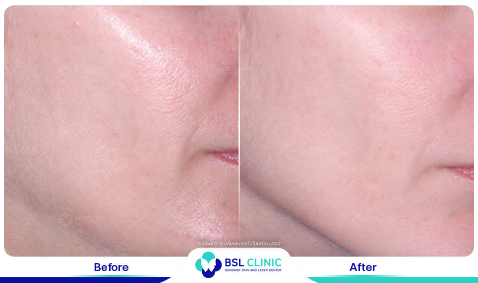 before afte Face Lifting Treatments