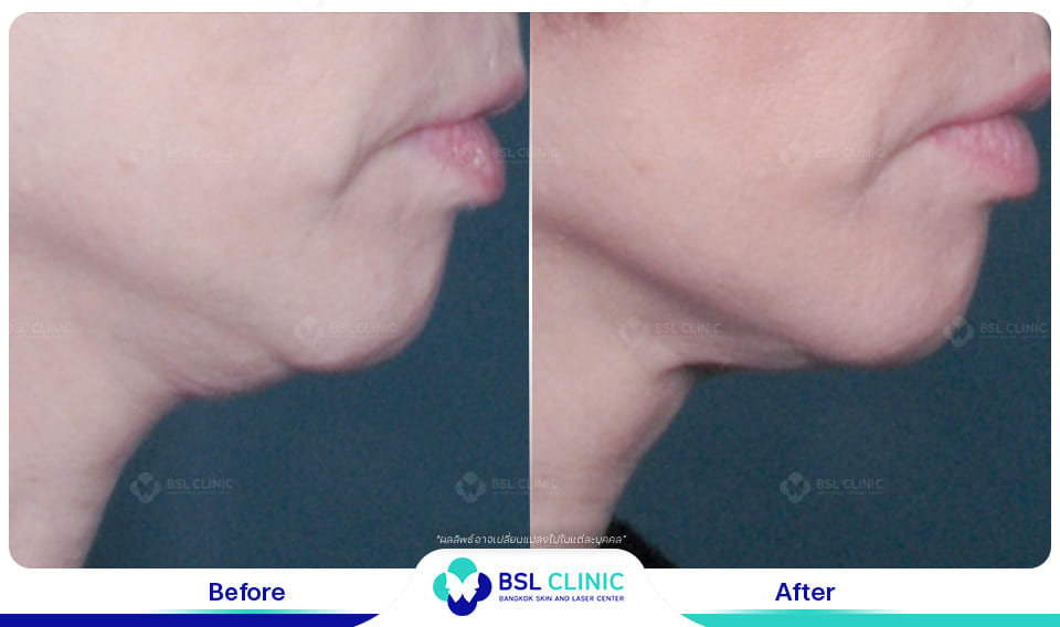 before afte Face Lifting Treatments