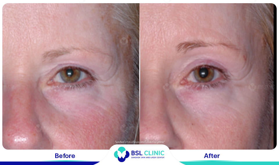 before afte Face Lifting Treatments