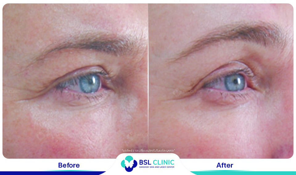 before afte Face Lifting Treatments