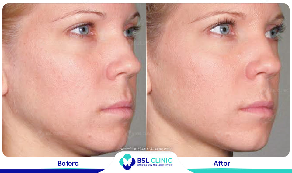 before afte Face Lifting Treatments