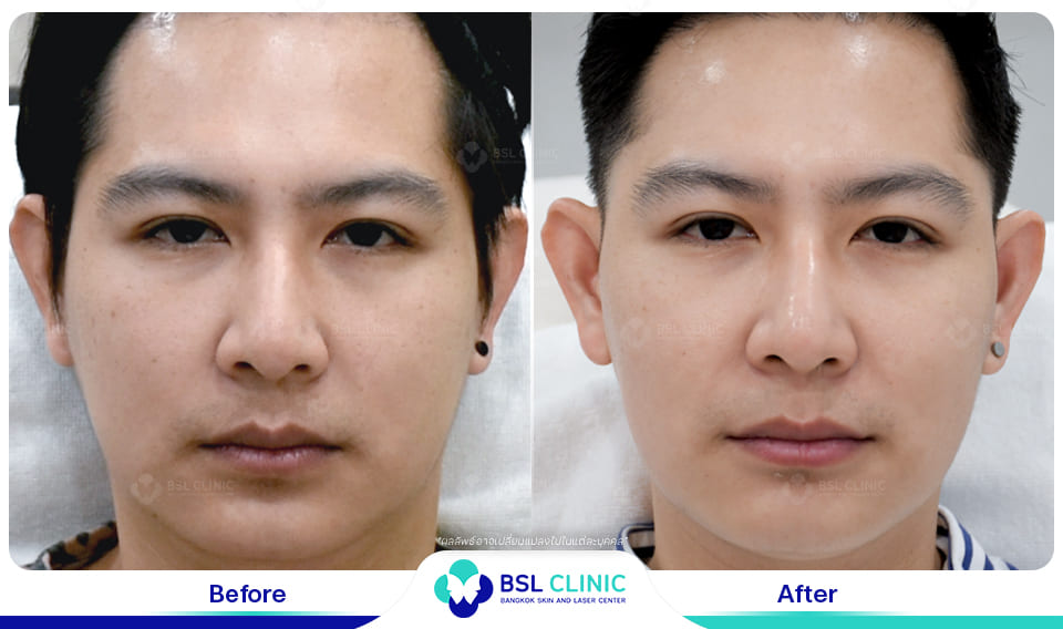 before afte Face Lifting Treatments
