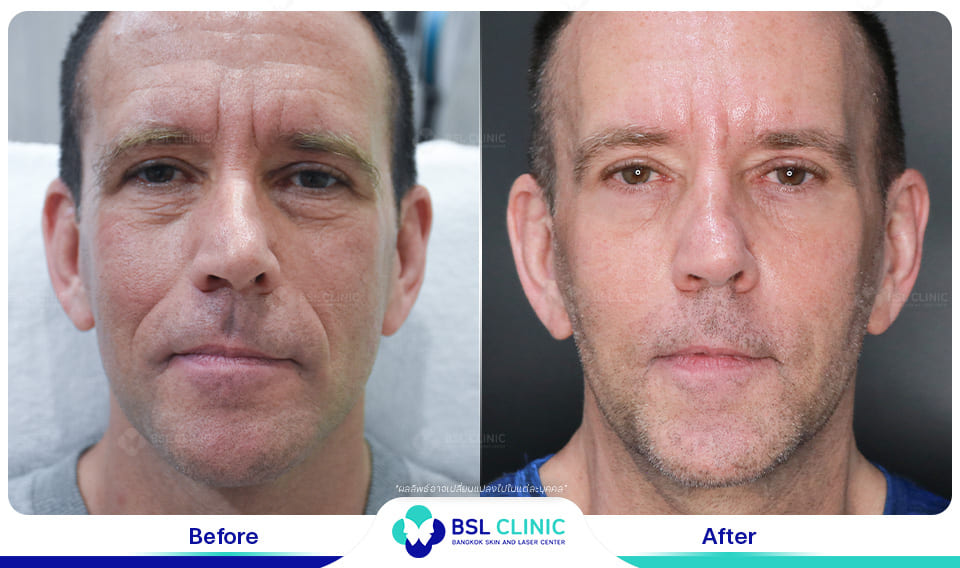 before afte Face Lifting Treatments