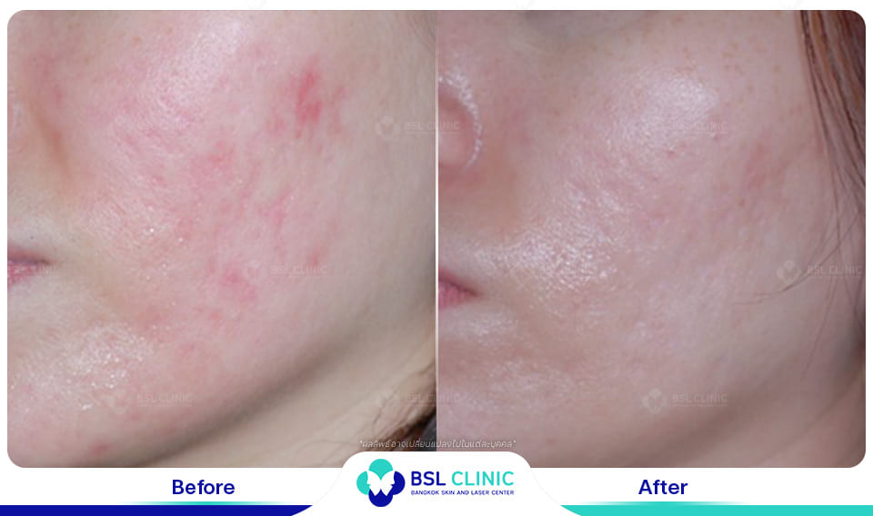 Red Birthmark and Facial Redness Treatments