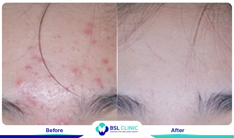 Red Birthmark and Facial Redness Treatments
