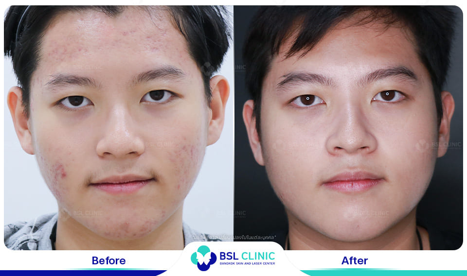 Red Birthmark and Facial Redness Treatments