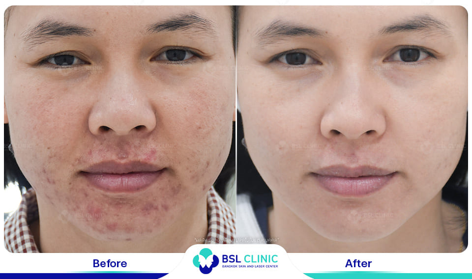 Red Birthmark and Facial Redness Treatments