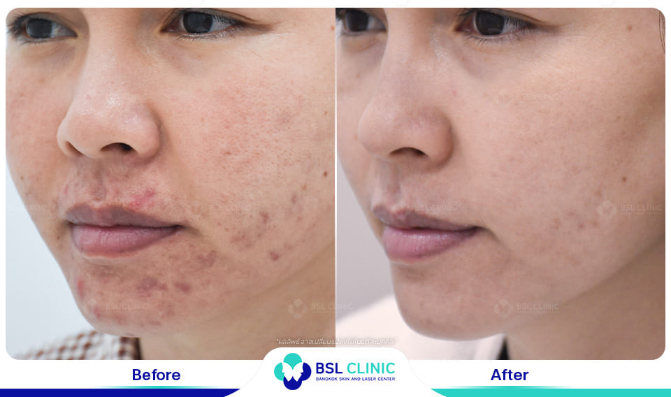 Red Birthmark and Facial Redness Treatments