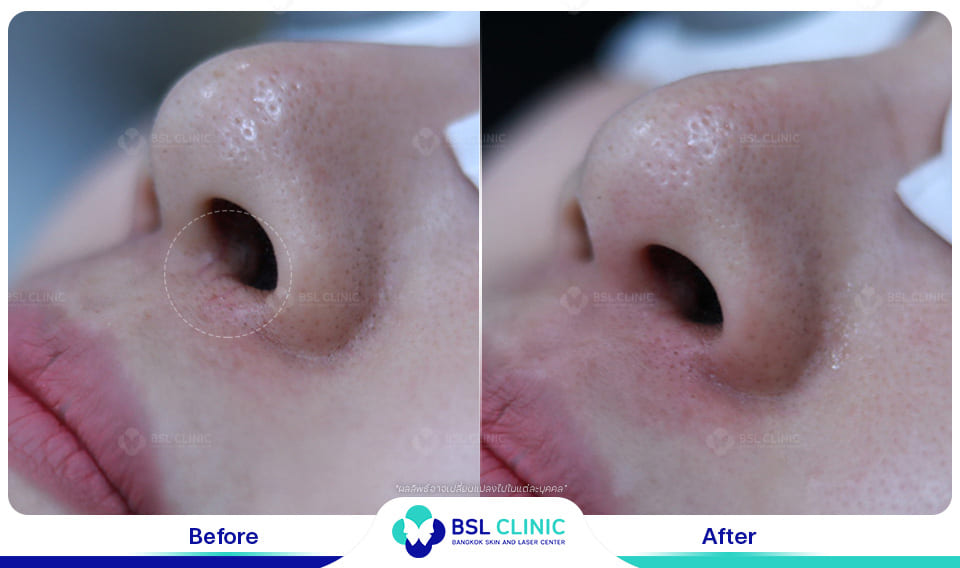 Red Birthmark and Facial Redness Treatments