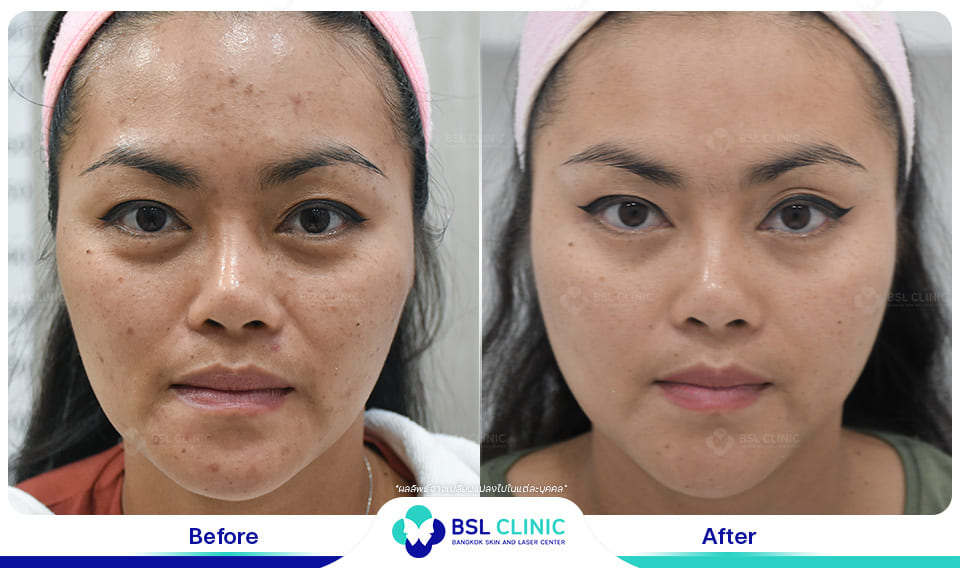 Skin Brightening and Whitening Treatment