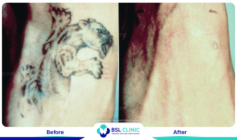 results tattoo removal